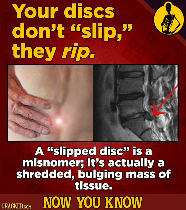 Your discs don't slip, they rip. A slipped disc is a misnomer; it's actually a shredded, bulging mass of tissue. NOW YOU KNOW CRACKED COM 