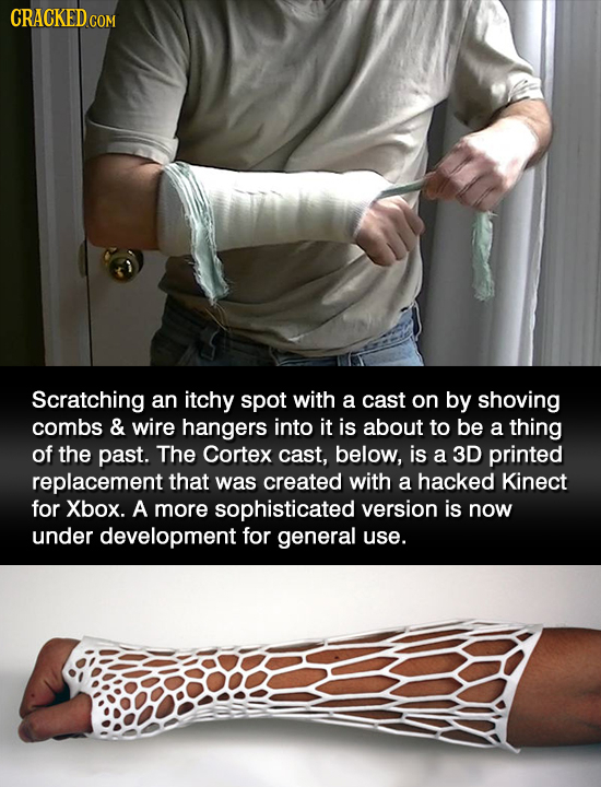 CRACKED CO Scratching an itchy spot with a cast on by shoving combs & wire hangers into it is about to be a thing of the past. The Cortex cast, below,