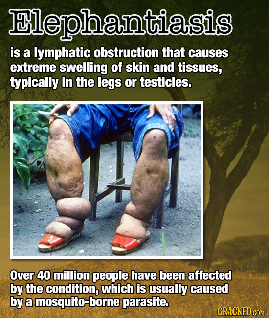 Elephantiasis is a lymphatic obstruction that causes extreme swelling of skin and tissues, typically in the legs or testicles. Over 40 million people