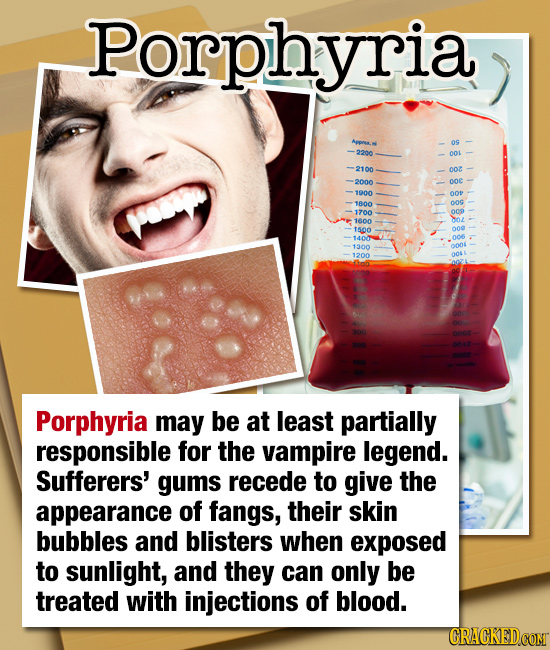 Porphyria ooZ O0c 1900 00 1700 Porphyria may be at least partially responsible for the vampire legend. Sufferers' gums recede to give the appearance o