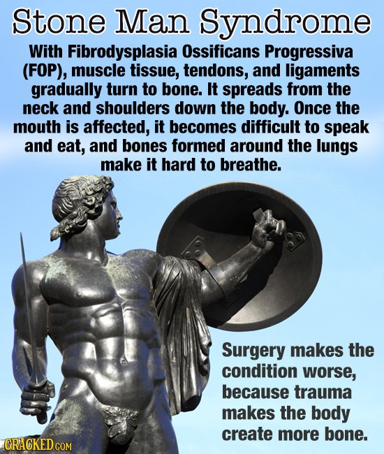 Stone Man Syndrome With Fibrodysplasia Ossificans Progressiva (FOP), muscle tissue, tendons, and ligaments gradually turn to bone. It spreads from the