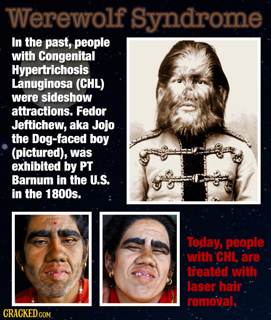 Werewolf Syndrome In the past, people with Congenital Hypertrichosis Lanuginosa (CHL) were sideshow attractions. Fedor Jeftichew, aka Jojo the Dog-fac