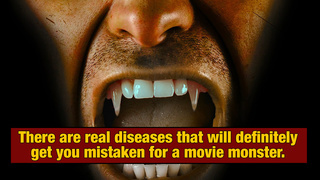 23 Horrifying Diseases That Sound Like Something Out Of A Movie