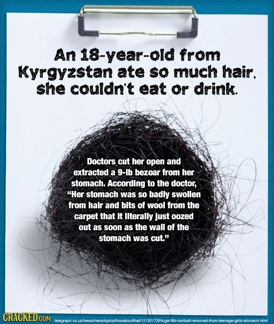 An 18-year-old from Kyrgyzstan ate so much hair, she couldn't eat or drink. Doctors cut her open and extracted a 9-lb bezoar from her stomach. Accordi