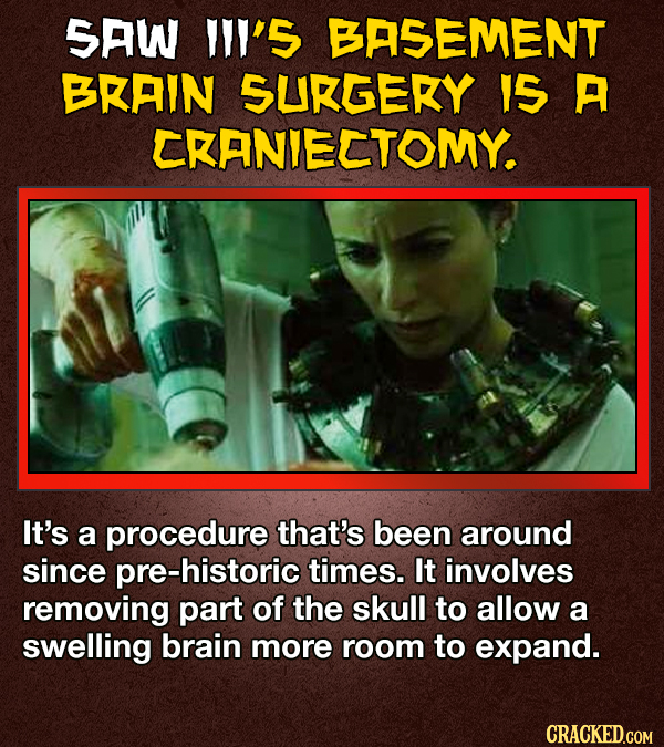 SAW 's BASEMENT BRAIN SURGERY IS A CKANIECTOMY. It's a procedure that's been around since pre-historic times. It involves removing part of the skull to allow a swelling brain more room to expand. CRACKED.GOM