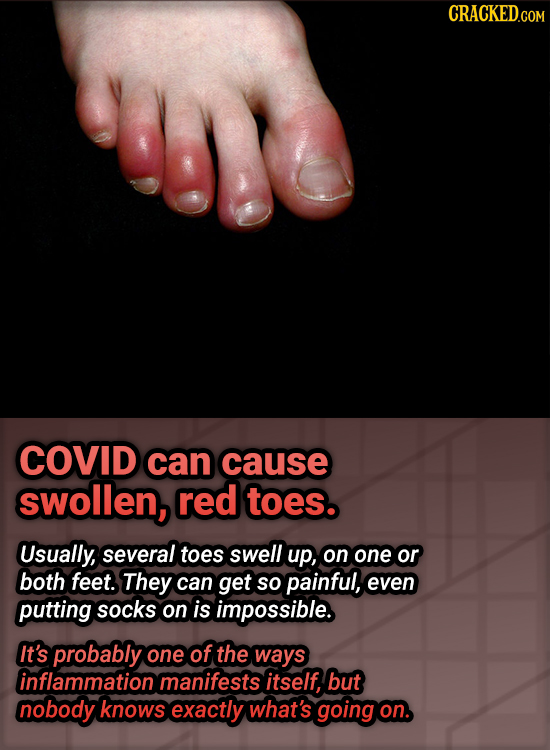 COVID can cause swollen, red toes. Usually, several toes swell up, on one or both feet. They can get So painful, even putting socks on is impossible.