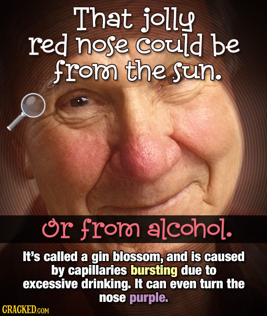 That jolly red nose could be fror the Sun. Or frorn alcohol. It's called a gin blossom, and is caused by capillaries bursting due to excessive drinkin