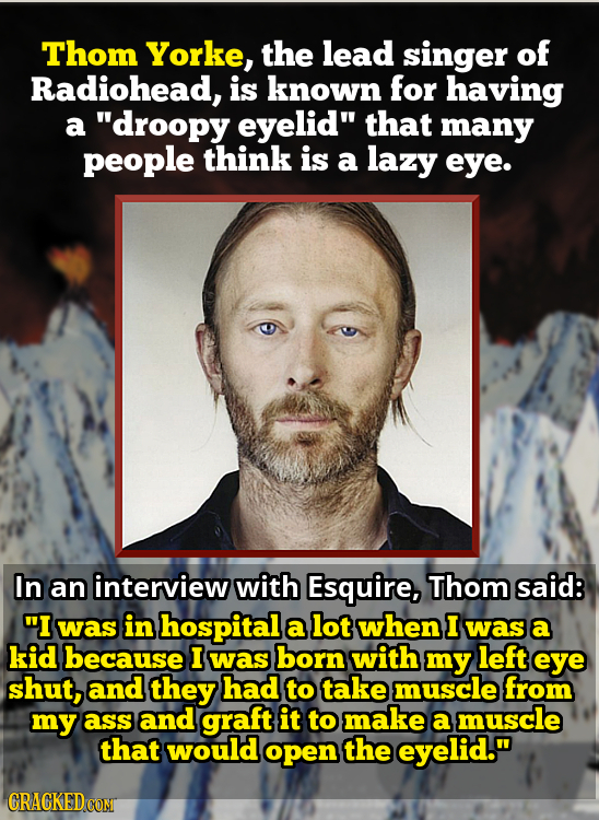 Thom Yorke, the lead singer of Radiohead, is known for having a droopy eyelid that many people think is a lazy eye. In an interview with Esquire, Th