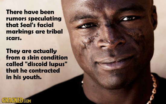 There have been rumors speculating that seal's facial markings are tribal scars. They are actually from a skin condition called discoid lupus that h