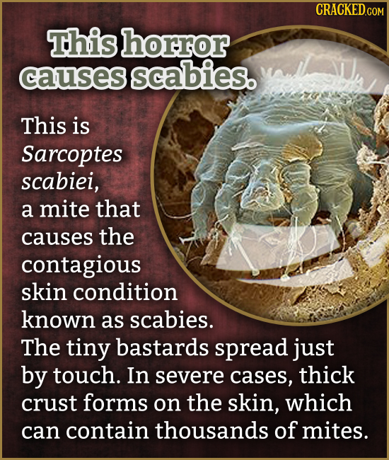 CRACKEDcO This horror causes scabies. This is Sarcoptes scabiei, a mite that causes the contagious skin condition known as scabies. The tiny bastards