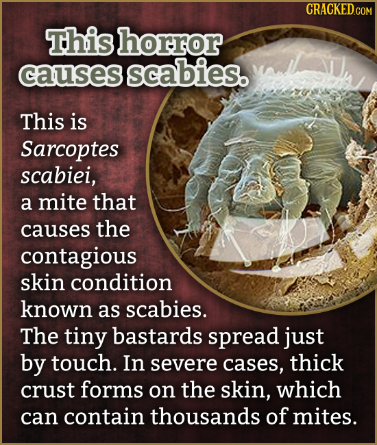 CRACKEDcO This horror causes scabies. This is Sarcoptes scabiei, a mite that causes the contagious skin condition known as scabies. The tiny bastards 