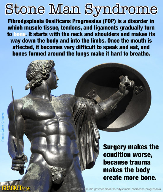 Stone Man Syndrome Fibrodysplasia Ossificans Progressiva (FOP) is a disorder in which muscle tissue, tendons, and ligaments gradually turn to bone. It