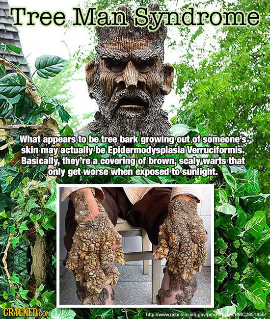 Tree Man Syndrome What appears to be tree bark growing out of someone's. skin may actually be Epidermodysplasia Verruciformis Basically, they're a cov