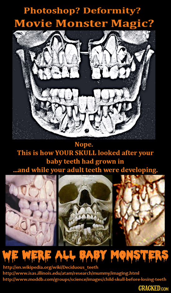 Photoshop? Deformity? Movie Monster Magic? Nope. This is how YOUR SKULL looked after your baby teeth had grown in ...and while your adult teeth were d