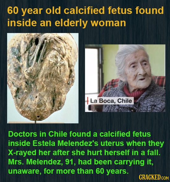 60 year old calcified fetus found inside an elderly woman La Boca, Chile Doctors in Chile found a calcified fetus inside Estela Melendez's uterus when