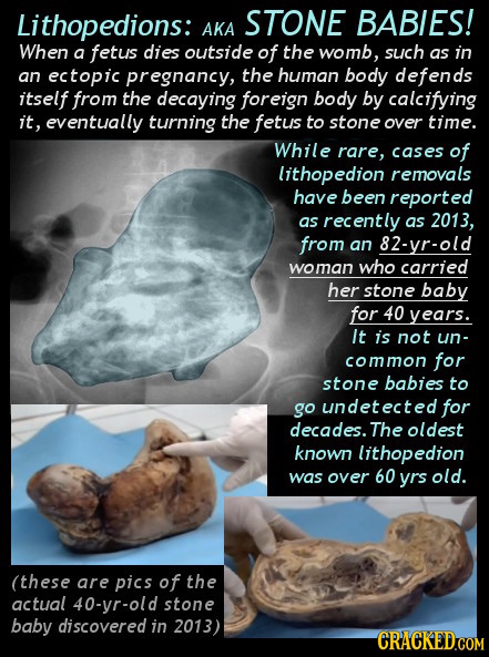 Lithopedions: STONE BABIES! AKA When a fetus dies outside of the womb, such as in an ectopic pregnancy, the human body defends itself from the decayin
