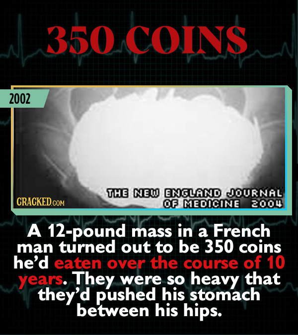 15 Weird Cases That Walked Into Doctors' Operating Rooms - A 12-pound mass in a French man turned out to be 350 coins he’d eaten over the course of 10