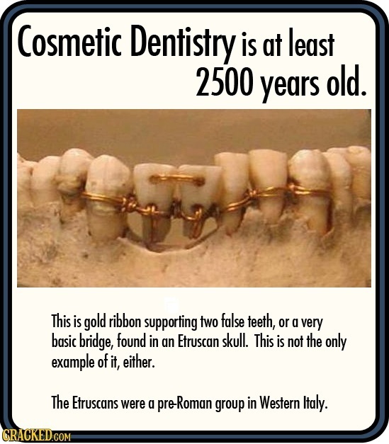 Cosmetic Dentistry is at least 2500 years old. This is gold ribbon supporting two false teeth, or a very basic bridge, found in skull. an Etruscan Thi