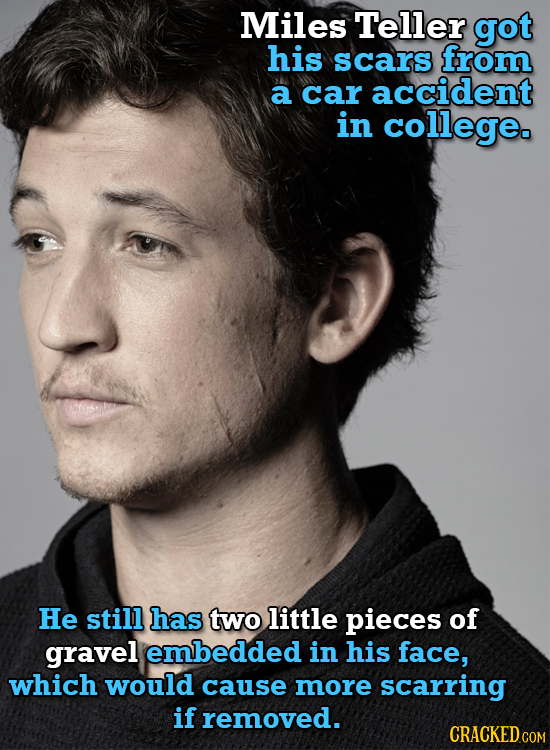 Miles Teller got his scars from a car accident in college. He still has two little pieces of gravel embedded in his face, which would cause more scarr