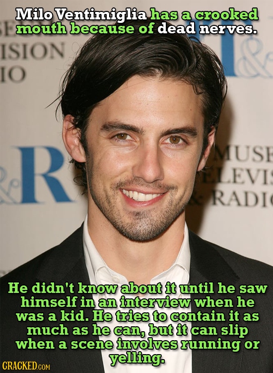 Milo Ventimiglia has a crooked mouth because of dead nerves. ISION IO R MUSE LEVI RADI He didn't know about it until he saw himself in an interview wh