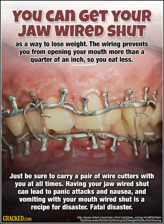 YOU CAN GET YOUR JAW WIRED SHUT as a way to lose weight. The wiring prevents you from opening your mouth more than a quarter of an inch, So you eat le