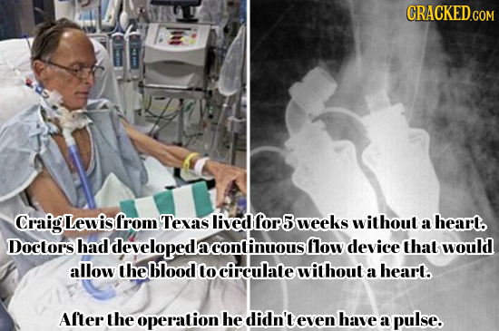 Craig Lewis from Texas lived for5 weeks without a heart. Doctors had developeda a continuoust flow device that would allow the blood to circulate with