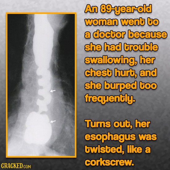 An 89-yearold woman went to a doctor because she had trouble swallowing, her chest hurt, and she burped too frequently. Turns out, her esophagus was t
