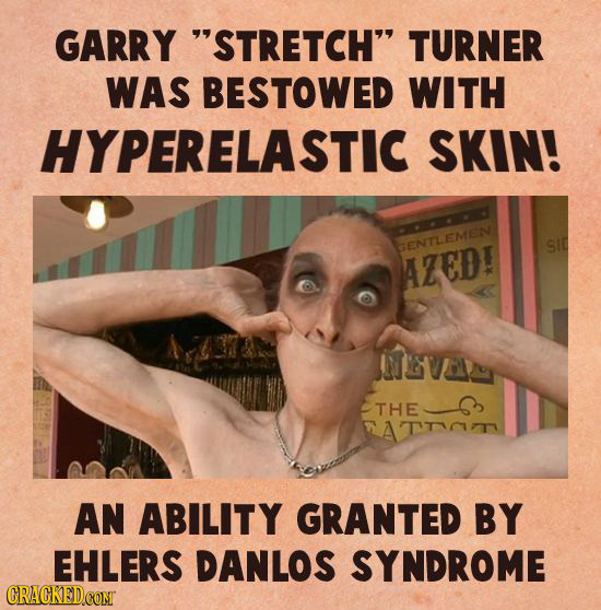 GARRY STRETCH TURNER WAS BESTOWED WITH HYPERELASTIC SKIN! GENTLEMEN SIC AZED! EVA THE ATTT AN ABILITY GRANTED BY EHLERS DANLOS SYNDROME CRACKED CONT