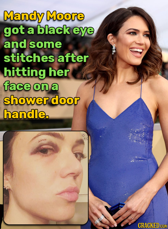 Mandy Moore got a black eye and some stitches after hitting her face on a shower door handle.