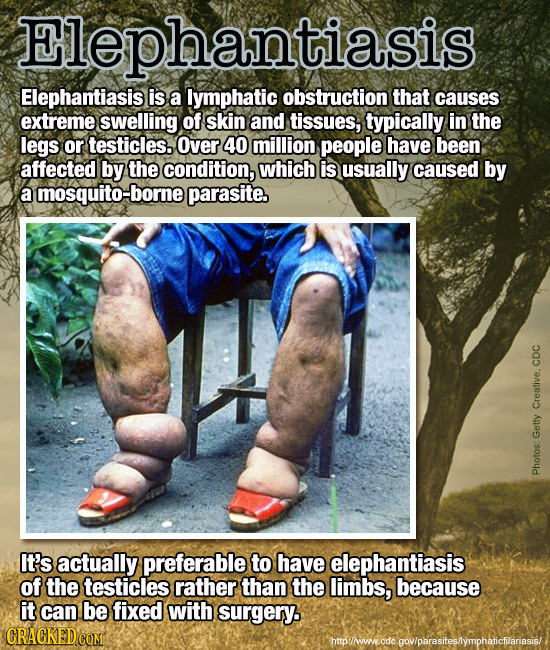 Elephantiasis Elephantiasis is a lymphatic obstruction that causes extreme swelling of skin and tissues, typically in the legs or testicles. Over 40 m