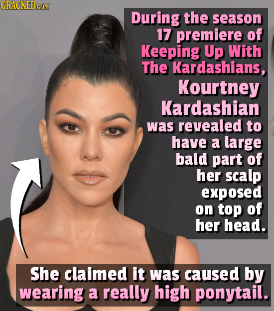 During the season 17 premiere of Keeping Up With The Kardashians, Kourtney Kardashian was revealed to have a large bald part of her scalp exposed on t