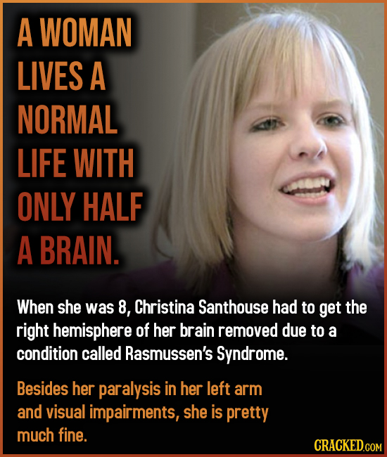 A WOMAN LIVES A NORMAL LIFE WITH ONLY HALF A BRAIN. When she was 8, Christina Santhouse had to get the right hemisphere of her brain removed due to a