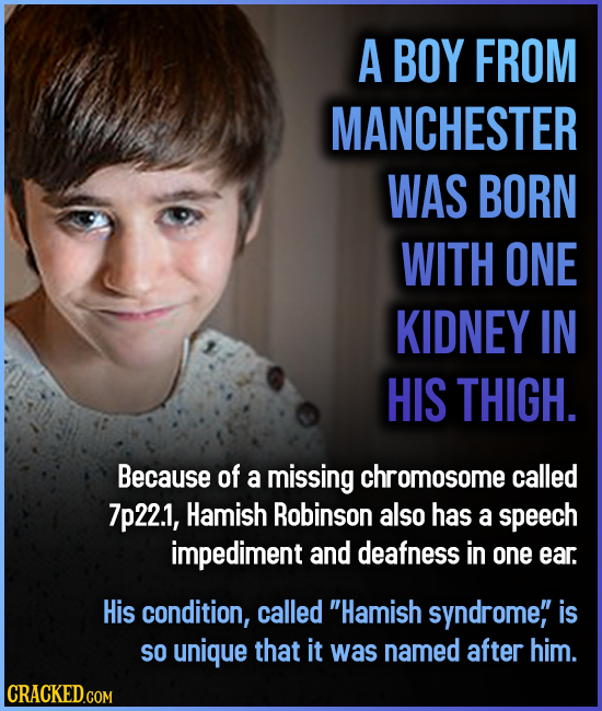 A BOY FROM MANCHESTER WAS BORN WITH ONE KIDNEY IN HIS THIGH. Because of a missing omosome called 7p22.1, Hamish Robinson also has a speech impediment