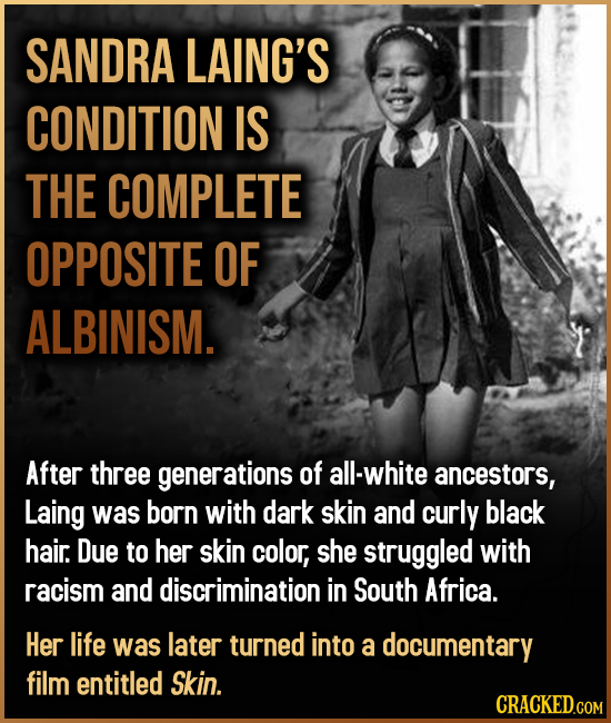 SANDRA LAING'S CONDITION IS THE COMPLETE OPPOSITE OF ALBINISM. After three generations of all-white ancestors, Laing was born with dark skin and curly