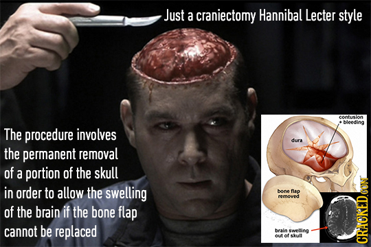 Just a craniectomy Hannibal Lecter style contusion +bleeding The procedure involves dura the permanent removal of a portion of the skull in order to a
