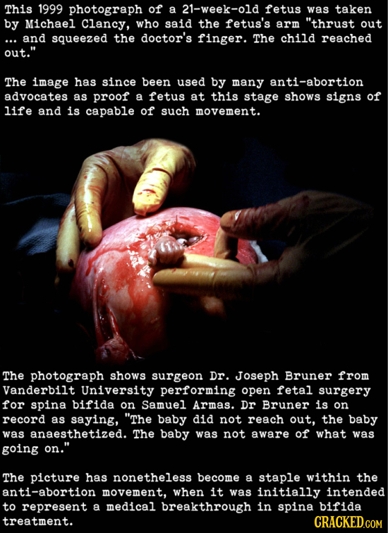 This 1999 photograph of a 21-week-old fetus was taken by Michael Clancy, who said the fetus's arm thrust out and squeezed the doctor's finger. The ch