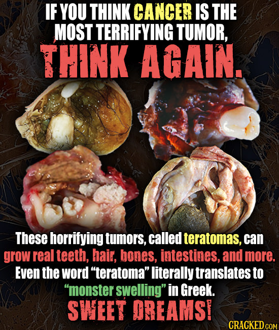 IF YOU THINK CANCER IS THE MOST TERRIFYING TUMOR, THINK AGAIN. These horrifying tumors, called teratomas, can grow real teeth, hair, bones, intestines