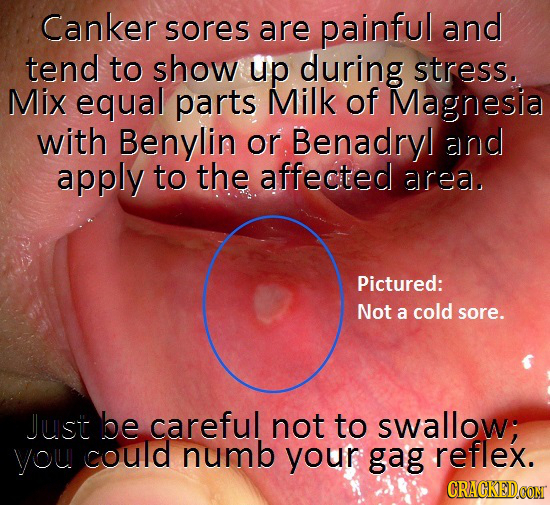 Canker sores are painful and tend to show up during stress. Mix equal parts Milk of Magnesja with Benylin or Benadry! and apply to the affected area. 