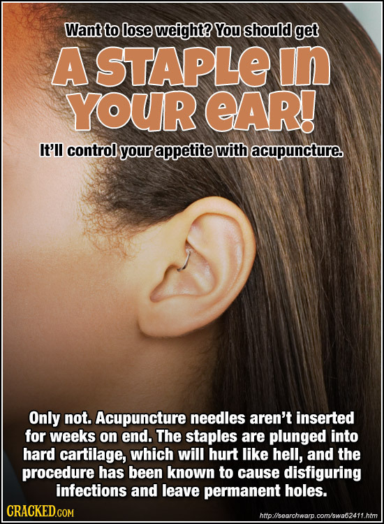 Want to lose weight? You should get A STAPLE in YOUR EAR! It'l control your appetite with acupuncture. Only not. Acupuncture needles aren't inserted f