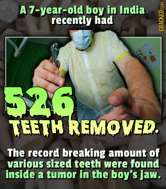 A7-year-old boy in India recently had CRAth 526 TEETH REMOVED The record breaking amount of various sized teeth were found inside a tumor in the boy's